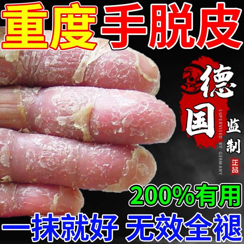 手脱皮严重脱皮专用口干燥粗糙开裂纹防真菌起蜕皮指足修复霜药膏