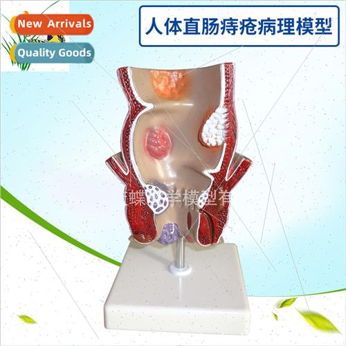 Lesion hemorrhoid model human rectal pathology model interna