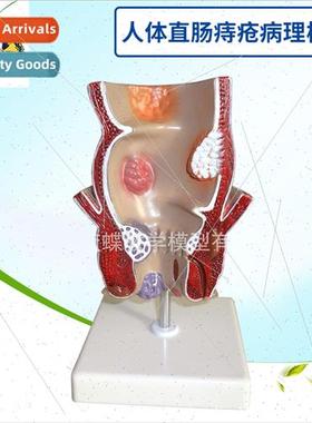 Lesion hemorrhoid model human rectal pathology model interna