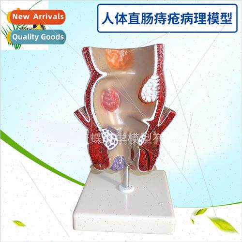 Lesion hemorrhoid model human rectal pathology model interna