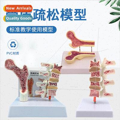 Human femur Osteoporosis lesion mbar spine anatomical model