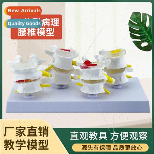 Four-stage lesion lumbar spine model Pathologic bone model D