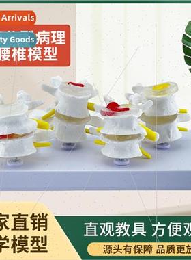 Four-stage lesion lumbar spine model Pathologic bone model D