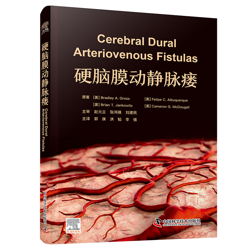 正版包邮 硬脑膜动静脉瘘 [美]布拉德利·A.,格罗斯,[Bradley,A.Gross],，等 9787523604724 中国科学技术出版社