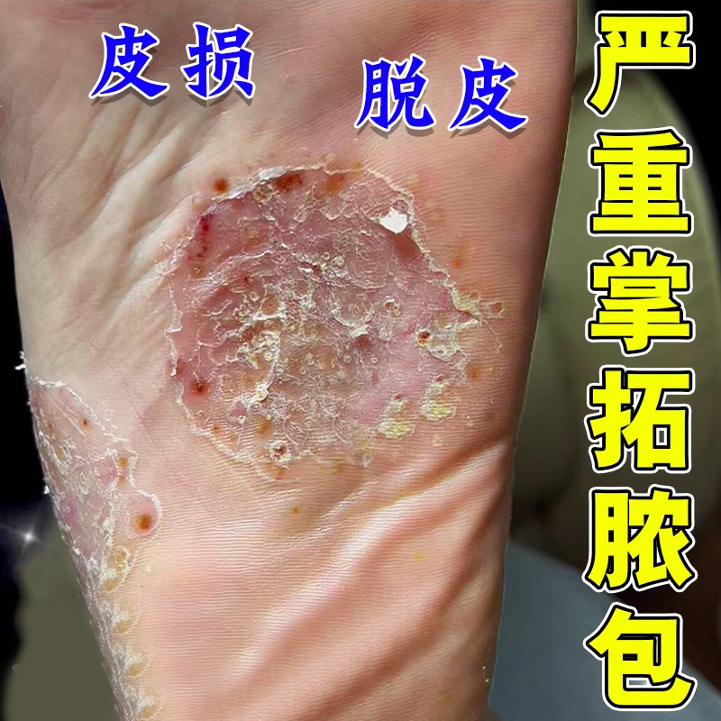 掌趾脓疱病专用掌跖角化症手脚脓包蜕皮干裂角皮症外用膏