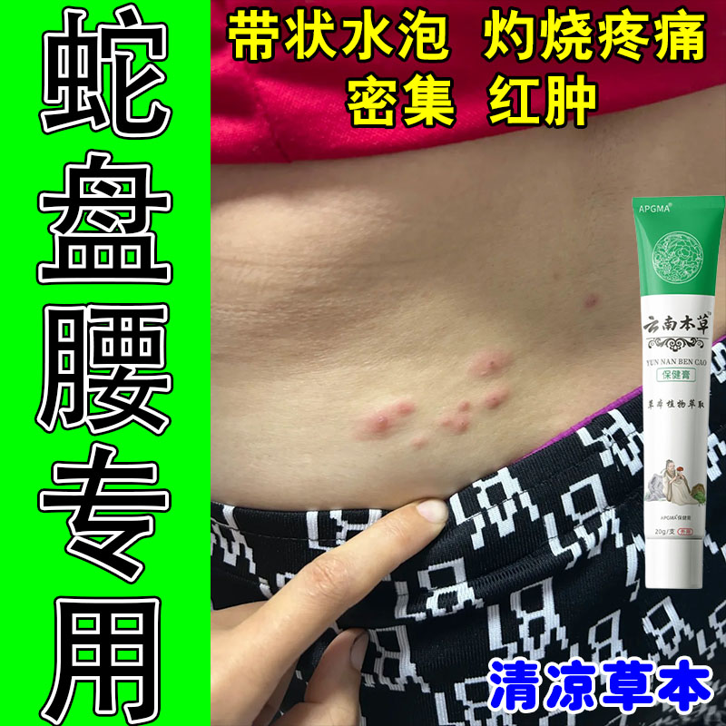 冶身上蛇缠带状红水泡腰腹水泡红肿刺痒灼热泛红修护植萃草本膏