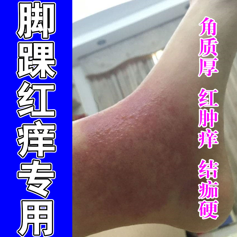 脚踝泛红痒起疙瘩皮肤干燥粗糙刺挠脚脖子长红斑脚踝发痒修复膏乳