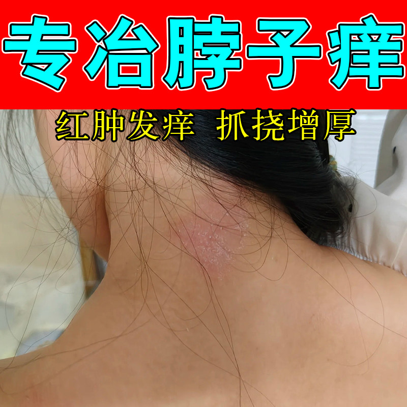 脖子皮肤过敏痒发红颈部上长红疙瘩出汗刺挠起红子干燥起皮乳膏