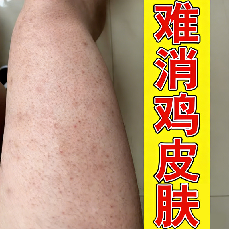 腿上鸡皮疙瘩小黑点全身适用去鸡皮小疙瘩软化毛周角质专用膏
