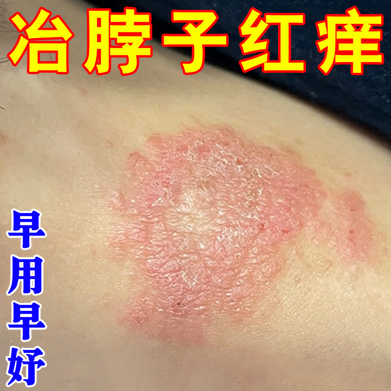 脖子后面痒刺挠颈部上起红疙瘩硬块干燥脱皮专用