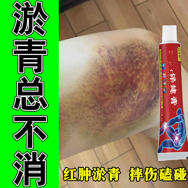腿上大片淤青活血化瘀儿童大人跌打损伤磕摔撞伤发紫消红肿专用膏