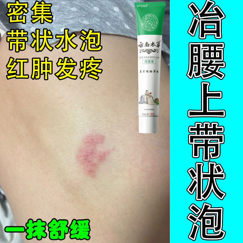 带状泡长腰上神经痛冶腰上皮肤疙瘩红肿刺痛修护保湿乳膏