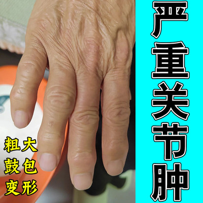 手指粗大鼓包修护膏缓解老人手指僵硬疼痛活动受限草本养护膏