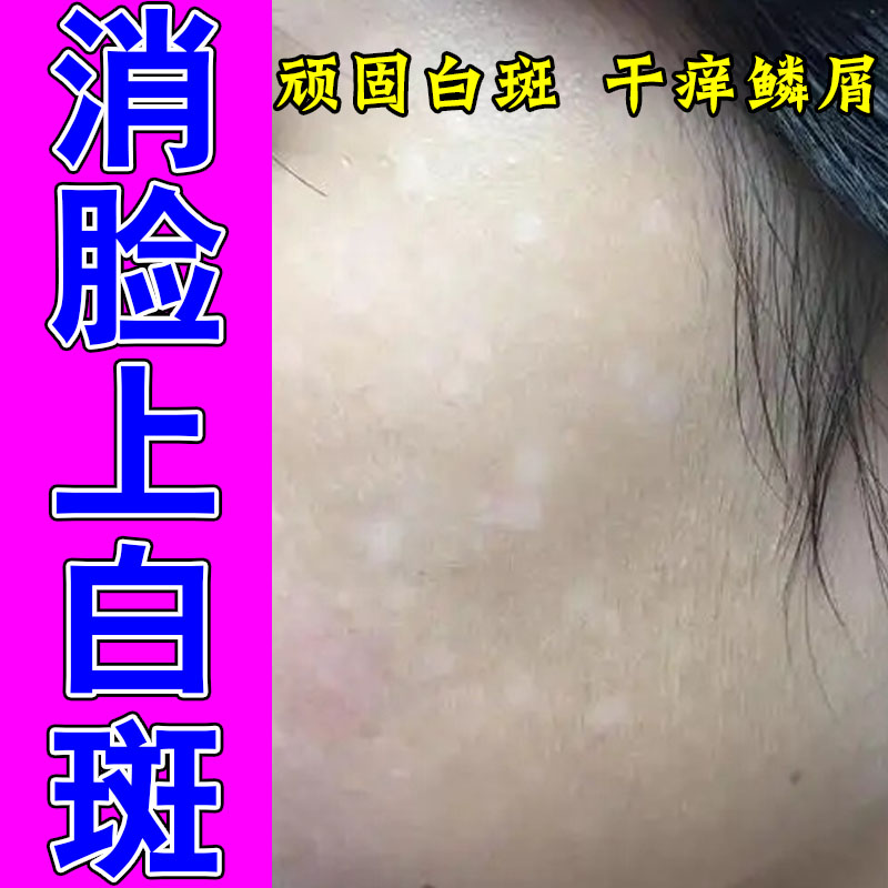 脸上长白斑白色干燥起皮屑白斑块明显缺少深色素汗斑花斑膏乳