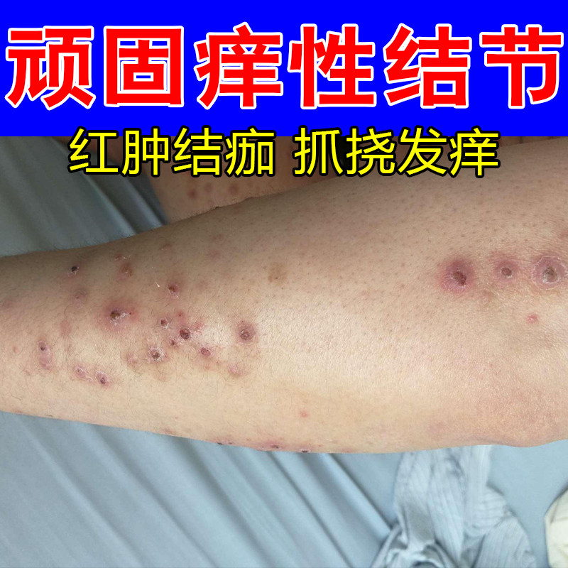 结节性疙瘩改善红肿硬块缓解全身肌肤红斑干痒不适修护软膏