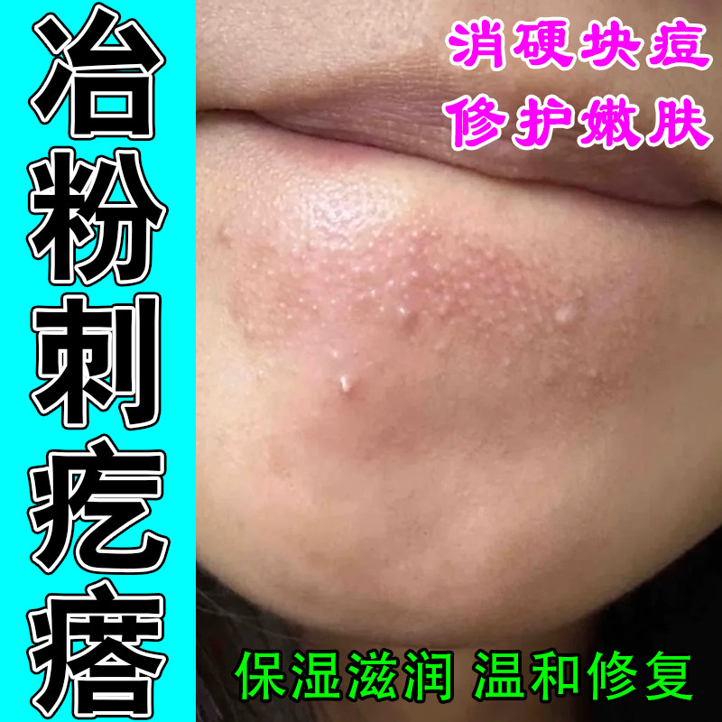 下巴闭口粉刺脸上额头包硬块内分泌失调粉刺疙瘩红痒修护保湿膏