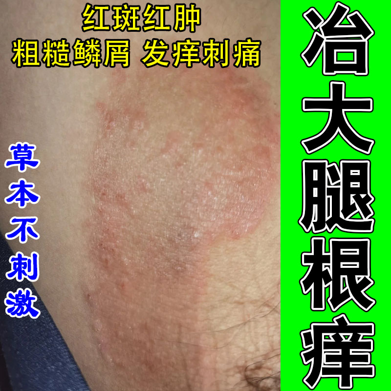 大腿部真菌内侧皮肤痒私处痒潮起小疙瘩红发黑干燥起屑痒修护乳膏