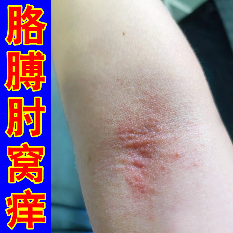 胳膊肘痒起疙瘩小红点干燥肘窝痒专用软膏