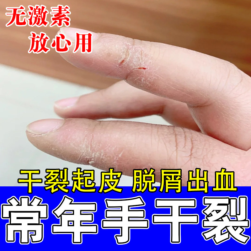 手指头裂口粗糙干裂口指甲边缘干燥手脱皮掉屑换季草本保湿膏