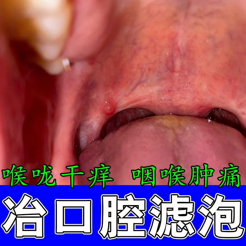 咽喉滤泡增生喉咙异物感咽喉壁发红灼热干痒水泡红肿修护喷剂