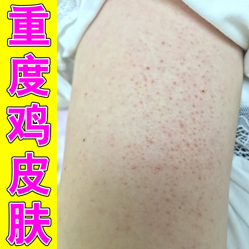 胳膊鸡皮疙瘩去除毛周角化手臂鸡皮去除毛囊角质
