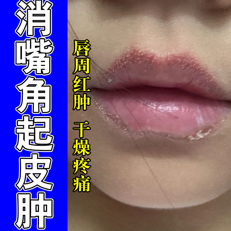 唇唇膏嘴唇干裂脱皮用型儿童专用死皮淡化唇纹死皮草本膏