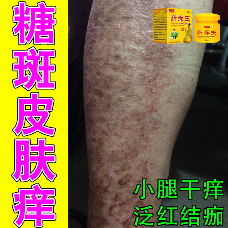 老人高糖肤质色素暗沉斑块全身皮肤干燥脱皮刺痒腿疼足草本舒缓膏