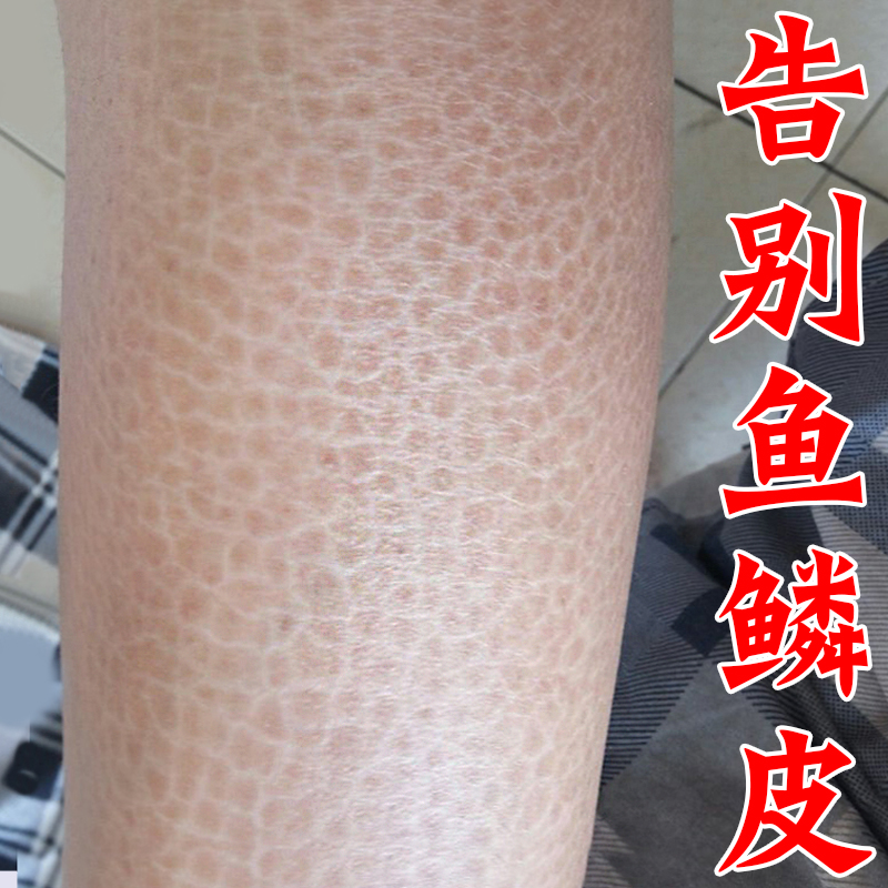 皮肤干燥保湿补水去鱼鳞皮小腿全身脱皮起皮掉皮病屑去干皮身体乳