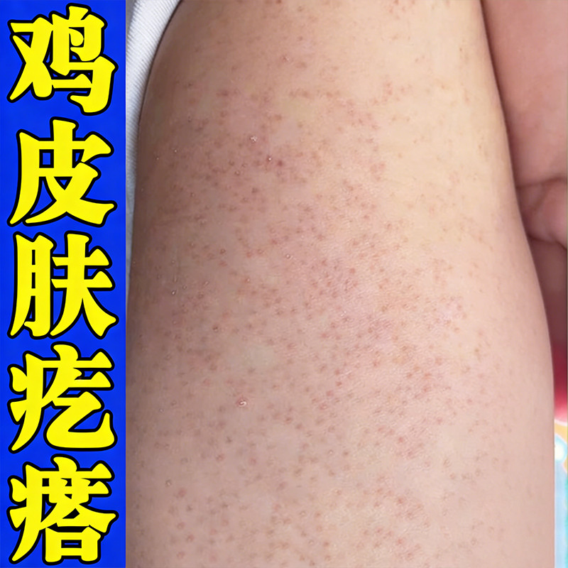 胳膊上起鸡皮疙瘩小黑点鸡皮毛囊角质修复抚平小疙瘩