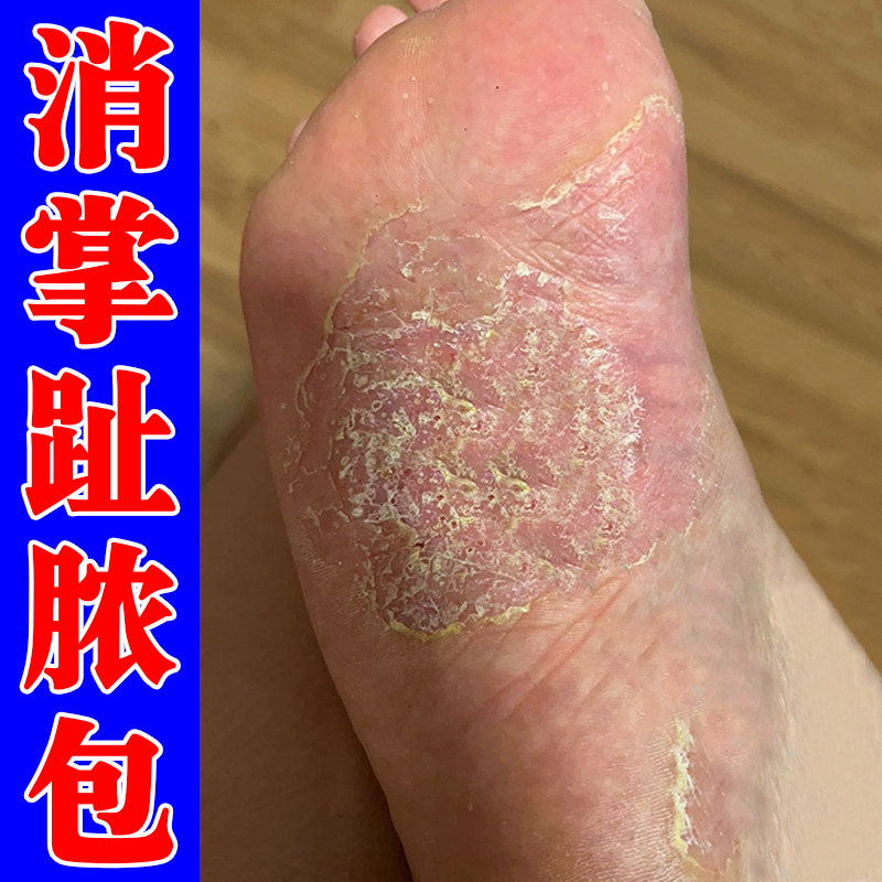 掌趾脓疱专用膏掌跖角化症手脚干裂蜕皮角皮症掌跖脓包