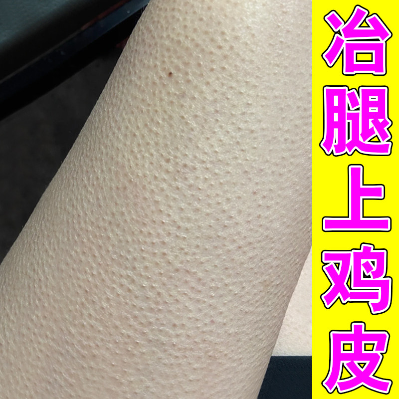 腿上小颗粒去腿部鸡皮毛囊小红点胳膊手臂鸡皮疙瘩软化角质