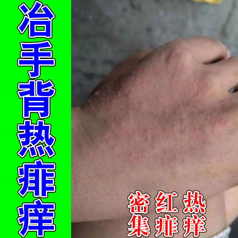 痱子天热身上红疙瘩大片发痒小疙瘩红点痒修护植物喷剂