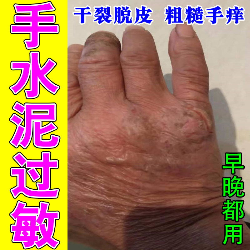 改善手部水泥过敏泛红干痒皮肤粗糙裂口脱皮干裂刺痛草本舒缓乳膏