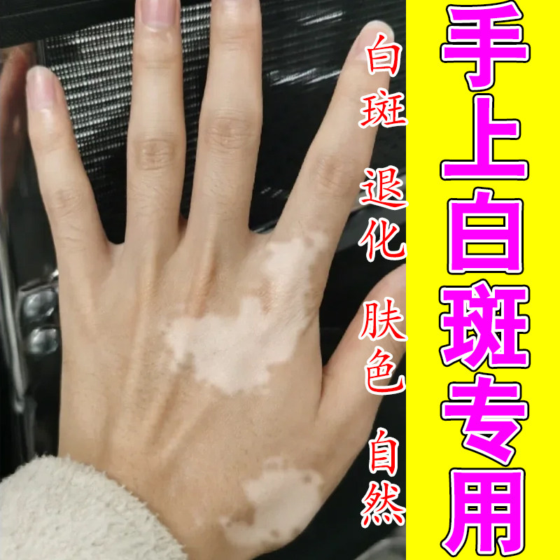 手背手指长白斑白色素外用修复促进黑色素生长补骨脂修护膏