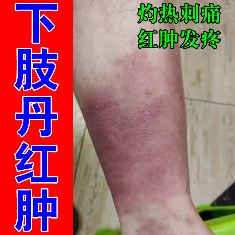 小腿下肢泛红大面积脚脖子疼痛肿胀灼热流火皮肤消肿草本膏