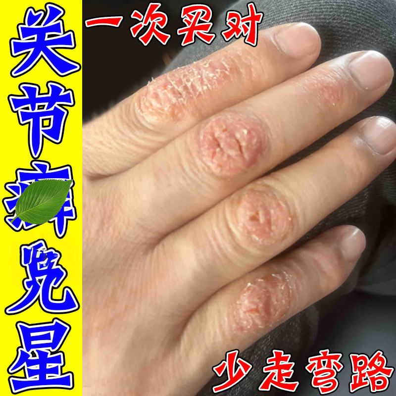 手指关节手指头上长硬疙瘩伤脱皮干裂膏