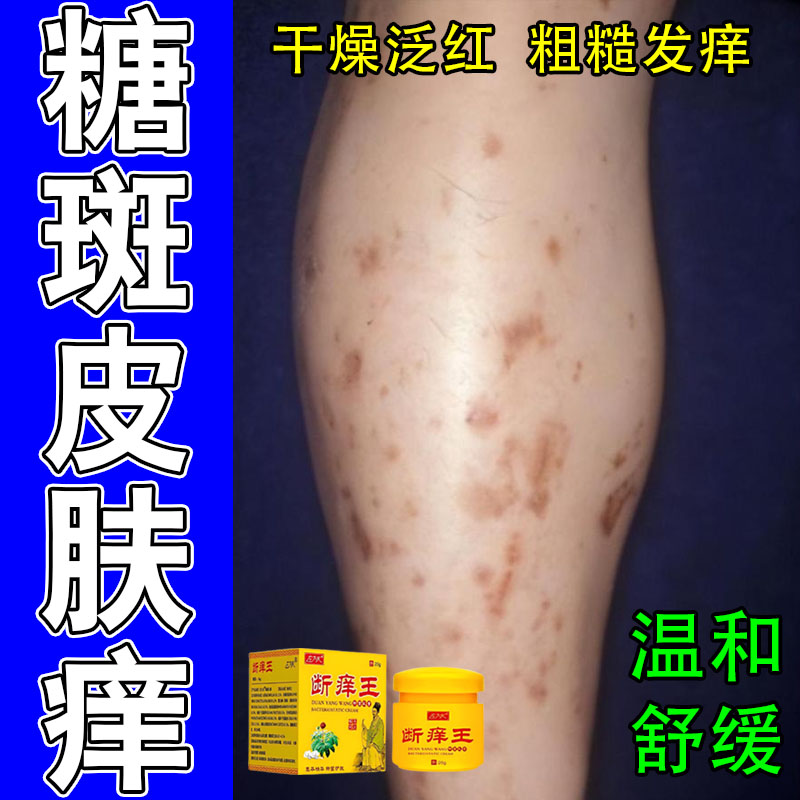 腿上小腿脚上褐色大块糖斑肌肤干痒起皮长疙瘩发痒暗沉植物修护膏