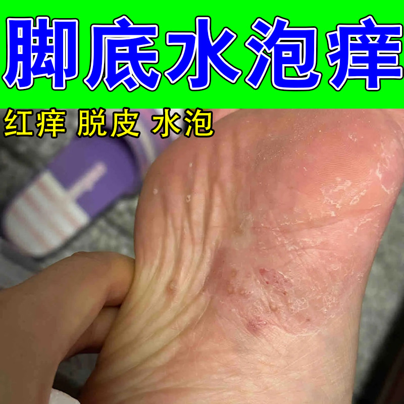 脚底水泡痒疙瘩起皮干燥粗糙干硬发红痒真菌舒缓修护软膏