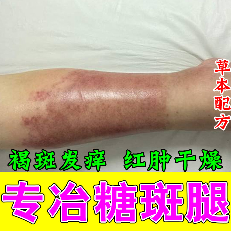 老人小腿足部肌肤干痒疙瘩糖化形成褐色大块斑皮肤发痒外用涂抹膏