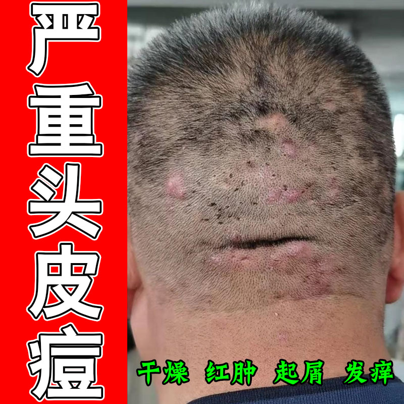 头皮毛囊疙瘩痘头上长疙瘩红痘疼脓包红肿起皮干燥草本修护软膏