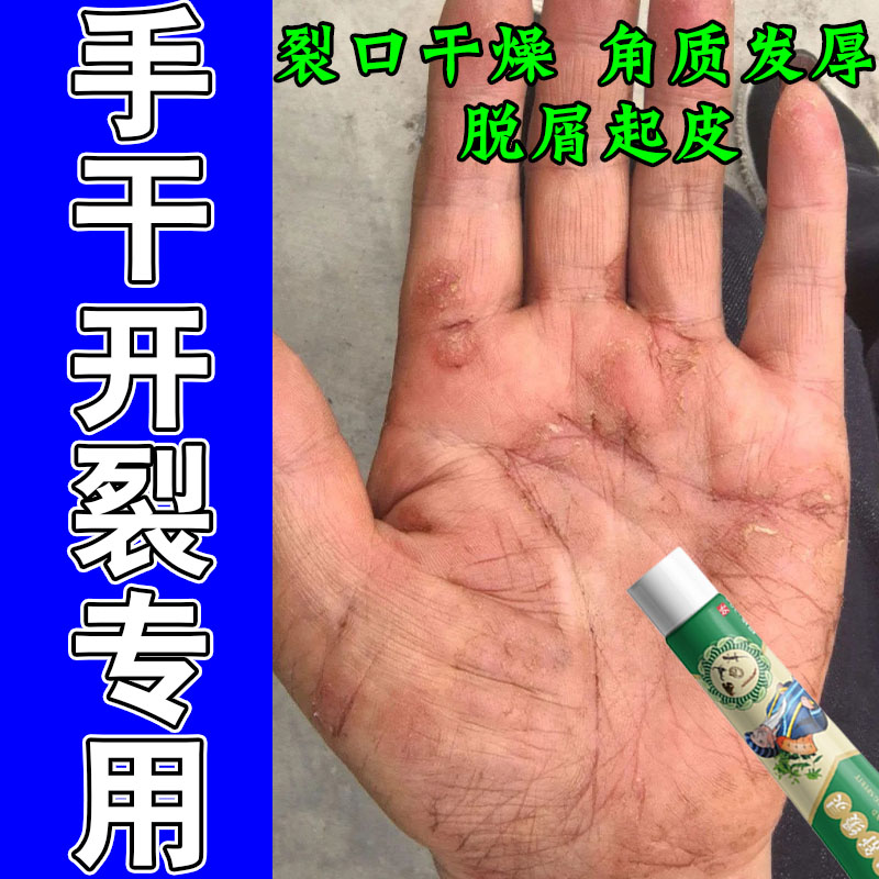 手掌干燥痒手指脱皮干裂开裂口手指关节起硬皮掉皮手痒外用膏