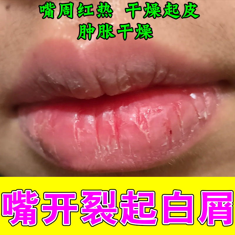 嘴角开裂干燥起皮嘴巴上火舔嘴角嘴角结痂出血唇膏专用