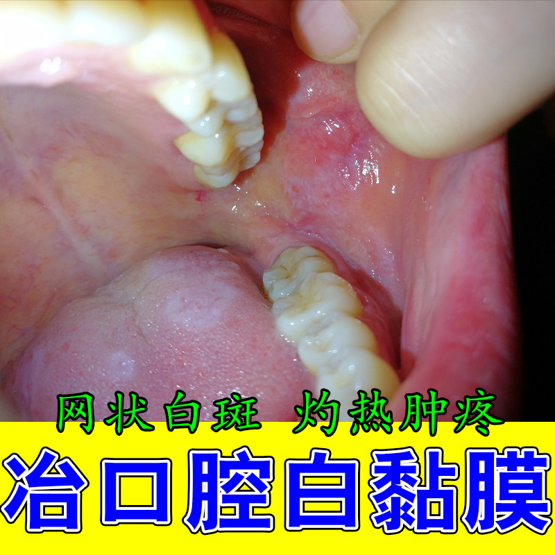 口腔扁平化黏膜白斑黏膜白斑舌头纤维化黏膜白色修护植物喷剂