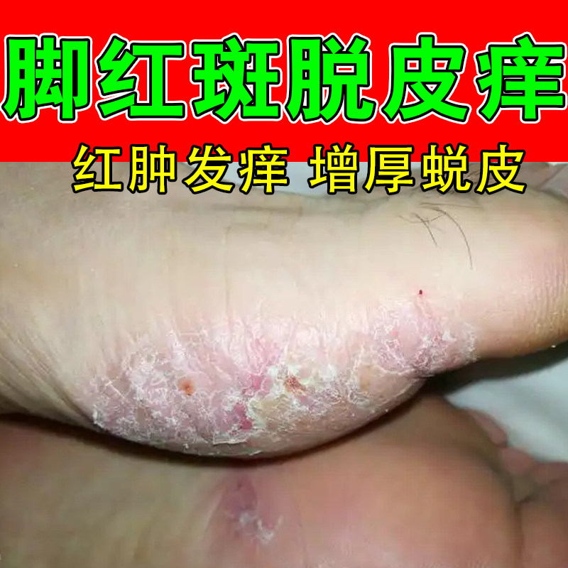 脚侧红干皮痒脚面粗糙痒脚侧红疙瘩脚面长痒红疙瘩干燥植物萃取膏