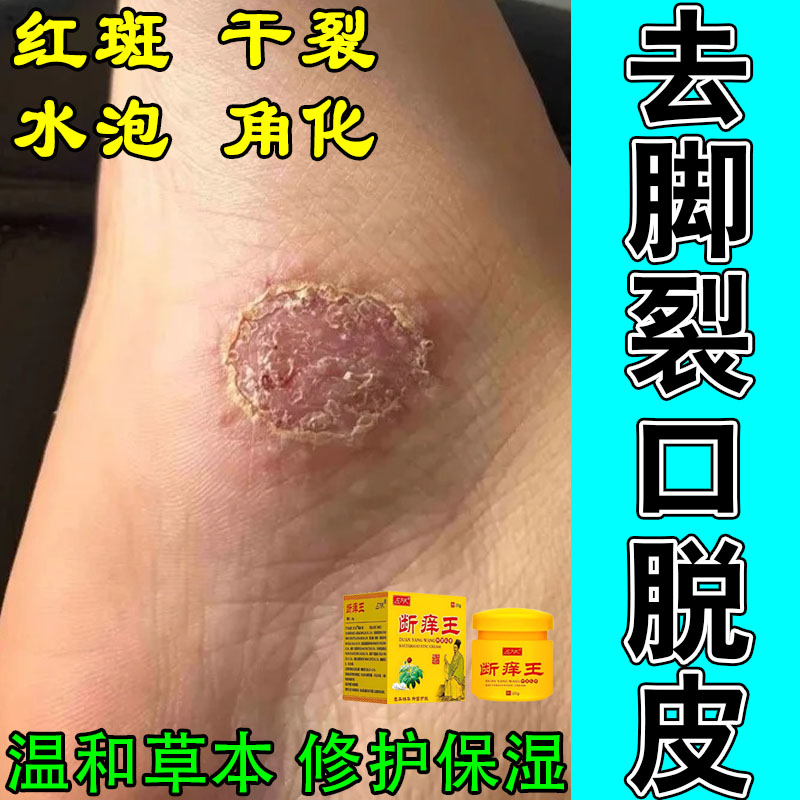 掌趾干裂泛红脱皮手掌脚掌角质厚重起皮粗糙干裂开口修护保湿软膏