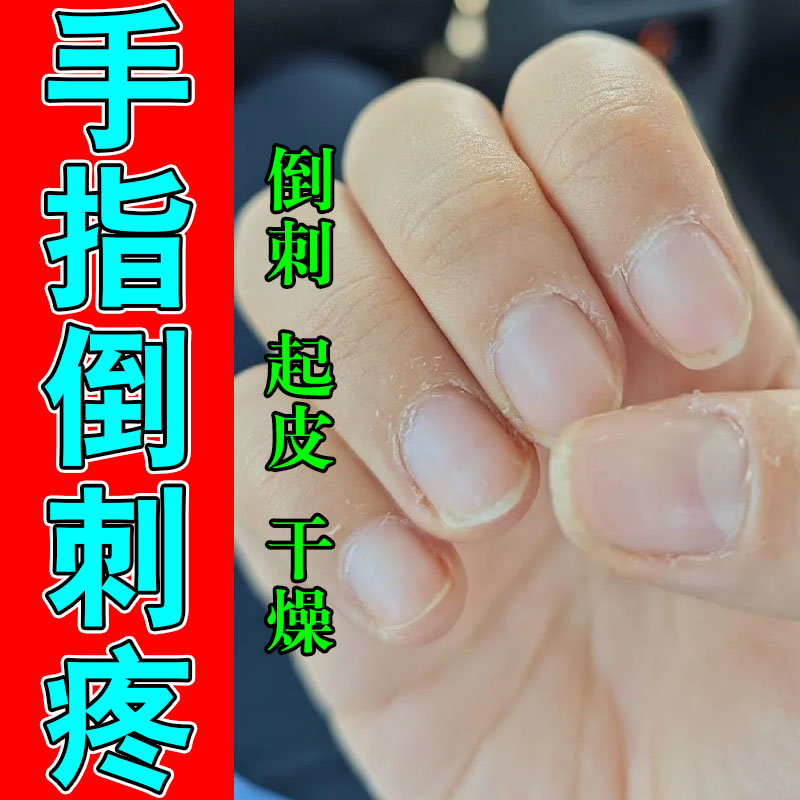 手指起倒刺修复受损儿童成人手上干裂脱皮肉刺疼专用保湿修护膏