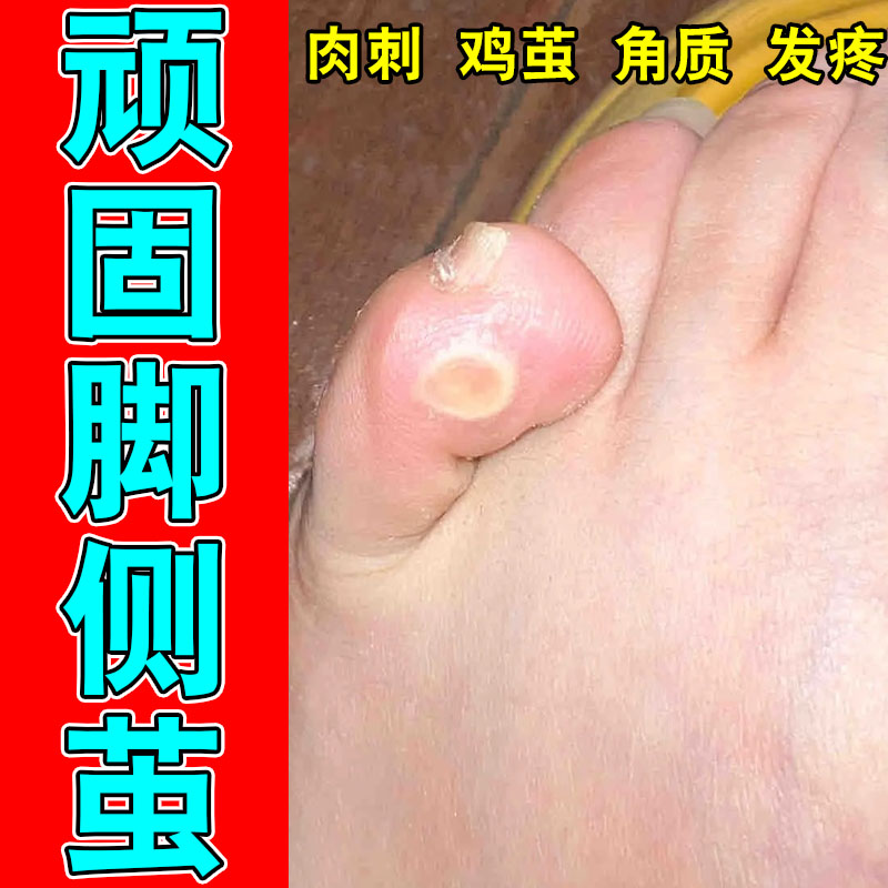 足部角质脚底脚垫脚趾关节老茧厚茧脚部硬茧脚钉修护贴