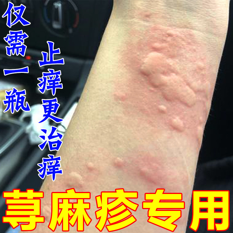 急慢风团胆碱性喷雾皮肤红肿疙瘩