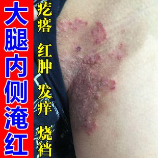 大腿内侧痒私处皮肤发痒大腿两侧痒屁股起疙瘩