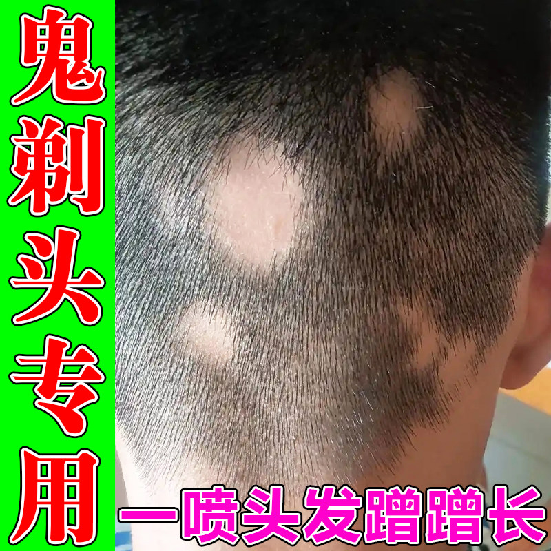 鬼剃头突发性斑秃头发一片一片掉皮肤消毒护理（消）